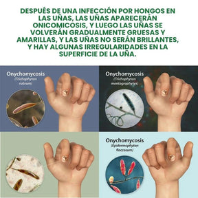 7 Days Fungus Free Nails® - Protege y elimina el hongo de tus Uñas (50ml)